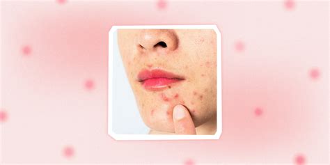 Cold Sore Or Pimple Corner Of Mouth