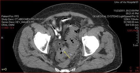 Colovesical Fistula Caused by an Ingested Chicken Bone - Urology