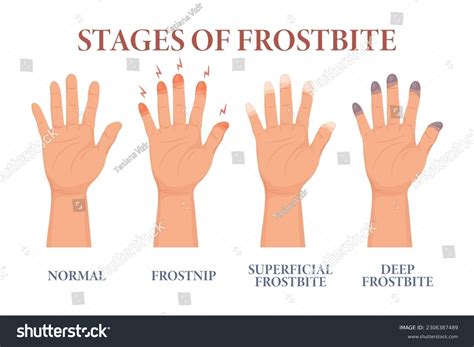 Vector Frozen Hands With Fingers. Medical Frostbite. Skin Burn Symptom ...