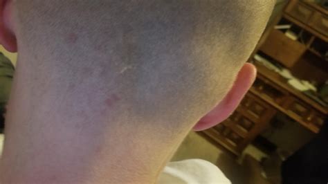 what is the reason I get these bumps on the back of my head after I shave? they look like ...