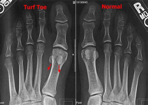Turf toe causes, signs, symptoms, recovery, diagnosis & turf toe treatment