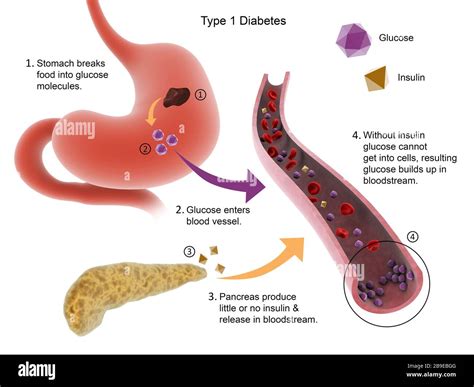 Medical diagram of Type 1 diabetes Stock Photo - Alamy