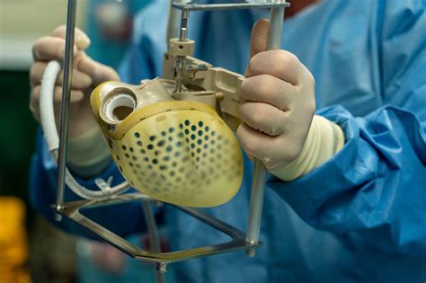 Artificial Heart Transplant Advantages at Marie Vaughan blog