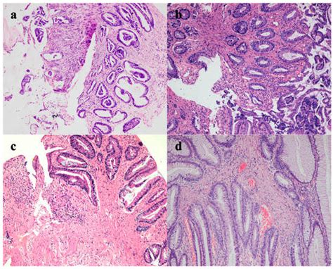 Solitary Rectal Ulcer Syndrome Is Not Always Ulcerated: A Case Report