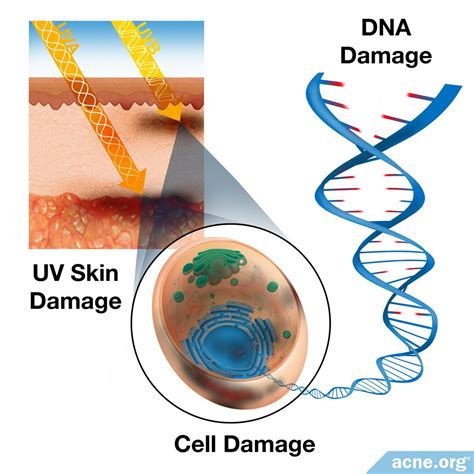 How Does Uv Radiation Affect Skin Cells at Maggie Marler blog