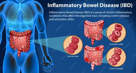 Enfermedad inflamatoria intestinal eii infografía | Vector Gratis