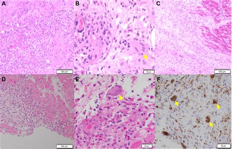 Two Cases of Giant Cell Myocarditis With Ocular Symptoms - Canadian Journal of Cardiology