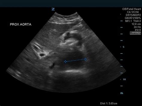 Bilateral Common Iliac Artery Aneurysm - JETem