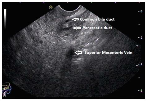 Endoscopic Ultrasound in Pancreatic Duct Anomalies
