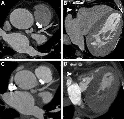 Accuracy of Ultrahigh-Resolution Photon-counting CT for Detecting Coronary Artery Disease in a ...