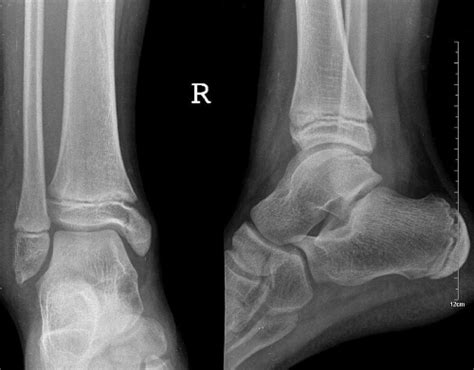 右脚外踝扭伤骨折已有1个半月-脚踝轻微骨折2个月才发现是骨折,请问怎样才恢复的快，左...