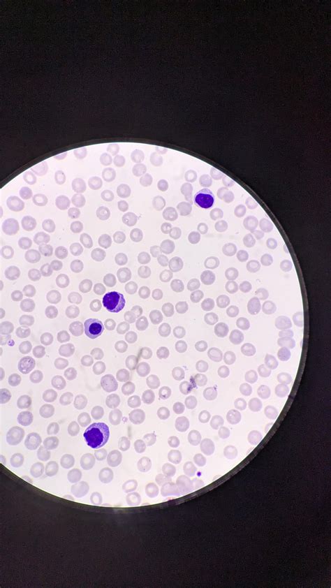 Plasma cell Leukaemia : r/Hematology
