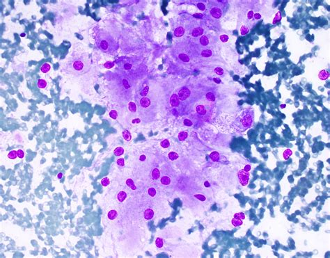Pathology Outlines - Alveolar soft part sarcoma