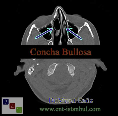 Concha Bullosa Ct Sinus