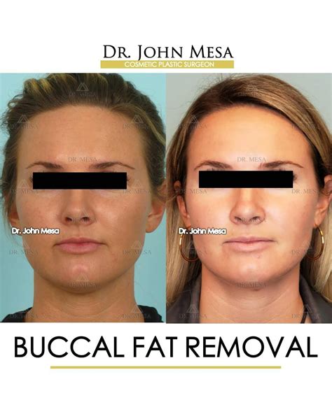 Buccal Fat Pad Removal Gallery