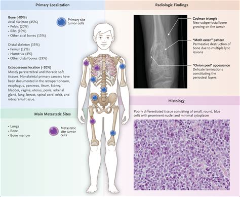 Ewing’s Sarcoma | NEJM