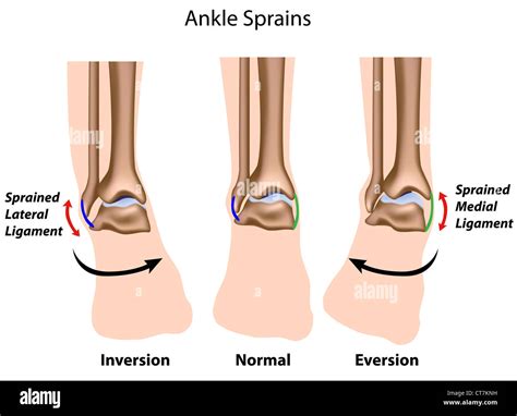 Types of Ankle sprains Stock Photo - Alamy