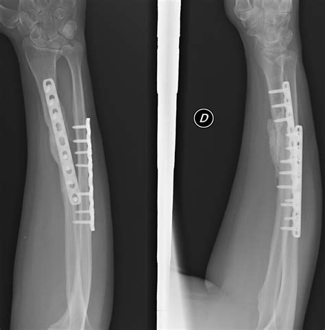Distal Radius Ulna Fracture Orthobullets at Beverly Browning blog