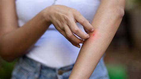 How to Get Rid of Arm Acne : Causes, Treatments, and Prevention Tips ...