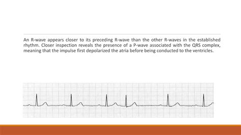 Abnormal ECG- Arhythmia.pptx