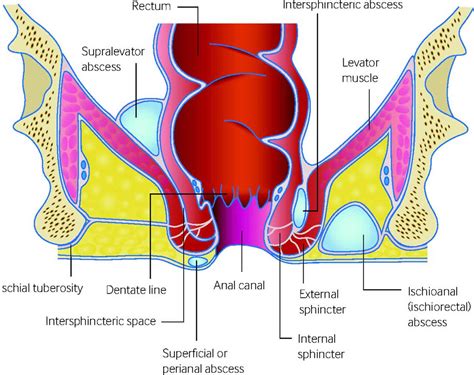 Perianal abscess causes, signs, symptoms, diagnosis, prognosis & treatment