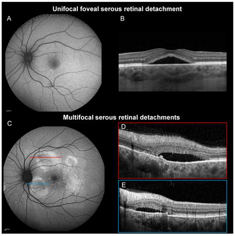 Clinical Characteristics and Multimodal Imaging Findings of Central Serous Chorioretinopathy in ...
