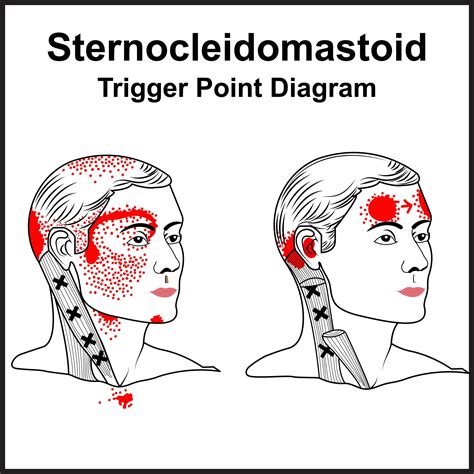 A Collection of Trigger Point Charts Head & Neck Muscle Pain Relief Chart Reflexology Charts ...