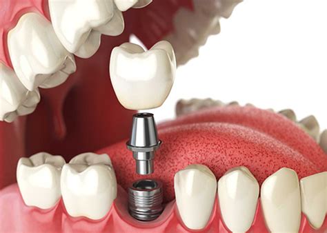 Anav Dental Care & Implant Center