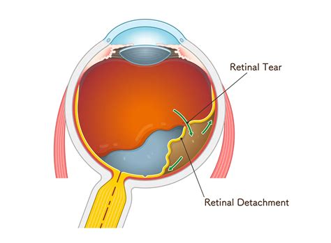 Retina Tear & Detachment | Symptoms, Treatment & Surgery