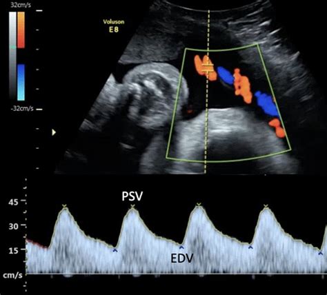 Bildergebnis für normal umbilical cord ultrasound