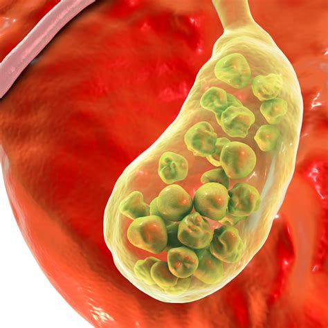 Gallstones: The Treatment and Prevention - Holistic Health On The Go