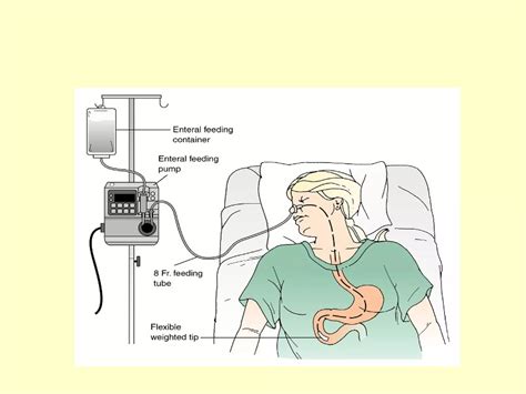 Nasogastric tube insertion | PPT