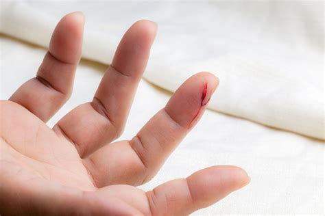 How to Treat a Cut on Your Finger