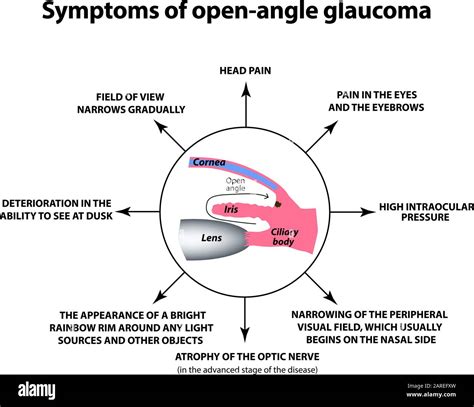 Symptoms of open-angle glaucoma. World glaucoma day. The anatomical structure of the eye ...