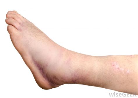 What are the Common Causes of Swelling in One Leg?