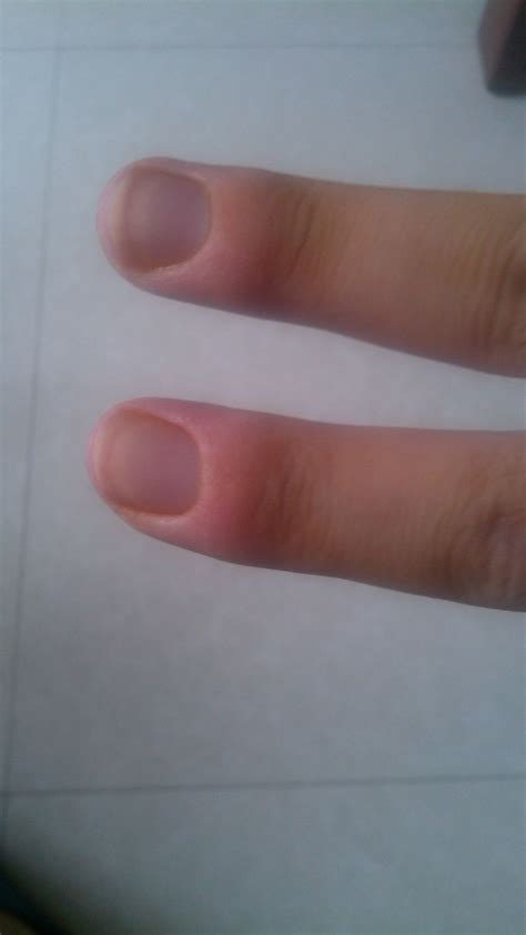 右手前一段时间第五掌骨骨折了，一个月以后拆了石膏。但是右手食指和中指最前面的指节肿的很厉害，啥回事_百度知道