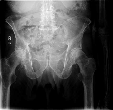 Radiopaedia case Multiple myeloma - with disseminated lytic skeletal lesions id: 31568 study ...