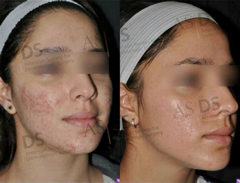 Non Ablative Fractional Laser