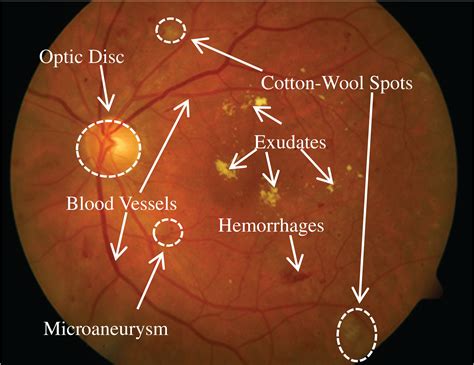 Cotton Wool Spots Vs Hard Exudates