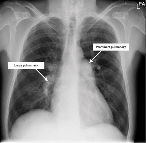 Pulmonary hypertension: a guide for GPs | British Journal of General ...