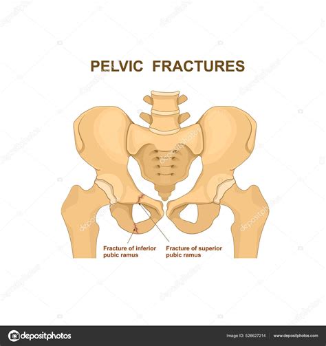 Fracture Treatment Inferior Pubic Ramus at Hayden Seekamp blog