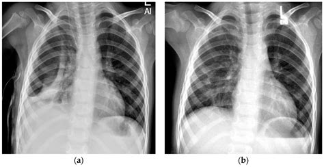 Pneumothorax After VATS for Pleural Empyema in Pediatric Patients