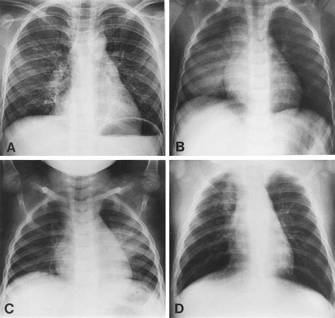 Bacterial Pneumonia Chest X Ray