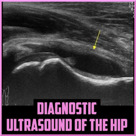 How to Perform Hip Ultrasound 的图像结果