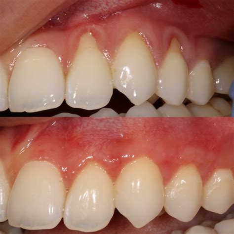Tooth Recession 的图像结果