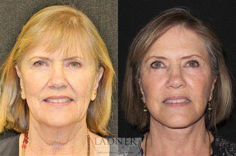 Facelift / Neck Lift Before and After Photo Gallery | Denver, CO | Ladner Facial Plastic Surgery