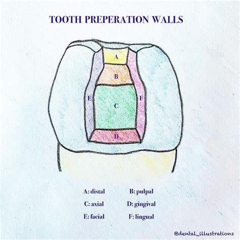 Dental IQ on Instagram: “Tooth preparation walls: . . Internal wall: a ...