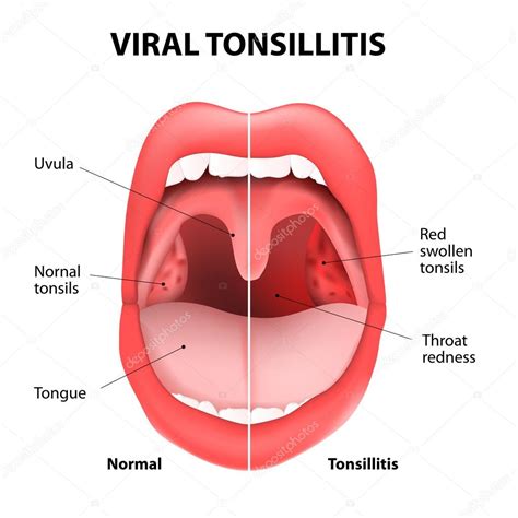 Normal Tonsils