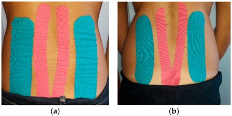 A Short Overview of the Effects of Kinesio Taping for Postural Spine ...