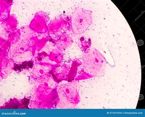 Microscopic Close View of High Vaginal Swab Bacterial Vaginosis (BV ...